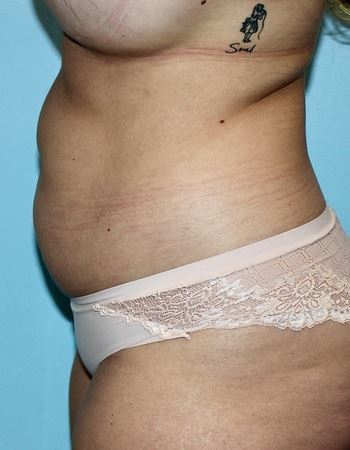 Case 4 Abdomen: Before