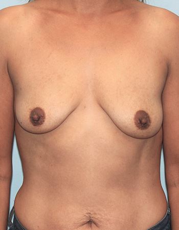 Case 13: Before