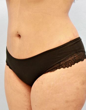 Case 1 Abdomen: After