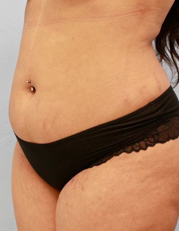 Case 1 Abdomen: Before