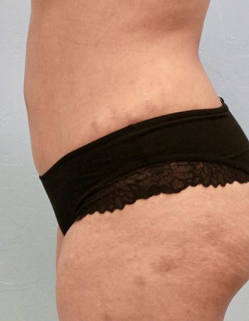 Case 1 Abdomen: After