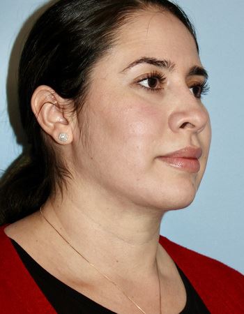 Case 2 Chin: After