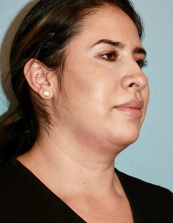 Case 2 Chin: Before