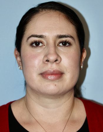Case 2 Chin: After