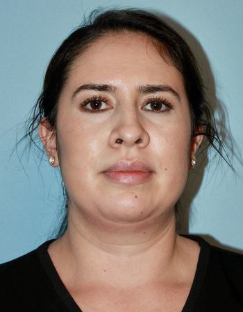 Case 2 Chin: Before