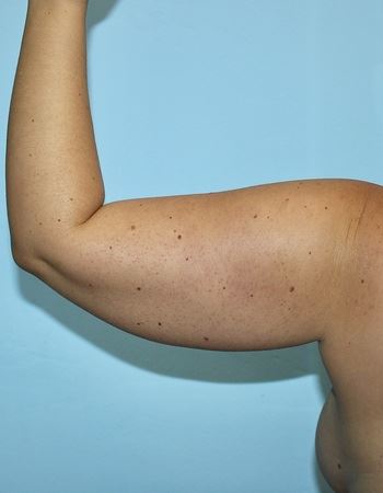 Case 3 Arm: Before