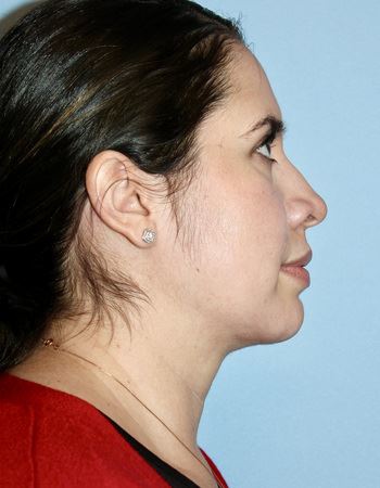 Case 2 Chin: After