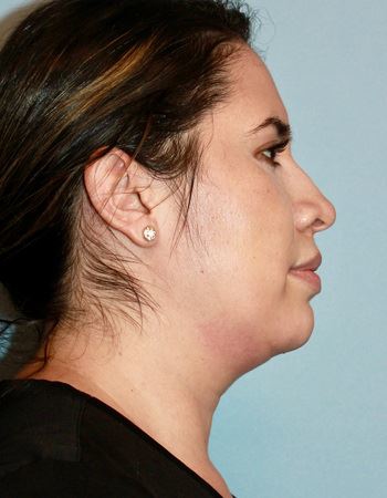 Case 2 Chin: Before