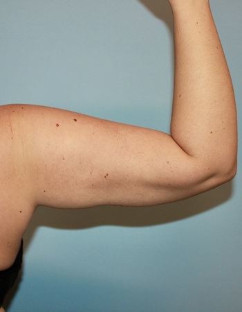 Case 3 Arm: After
