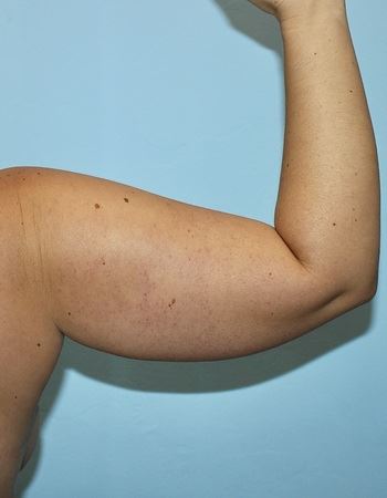 Case 3 Arm: Before