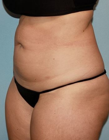 Case 4 Abdomen: After