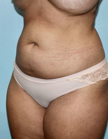 Case 4 Abdomen: Before