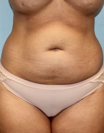 Case 4 Abdomen: Before