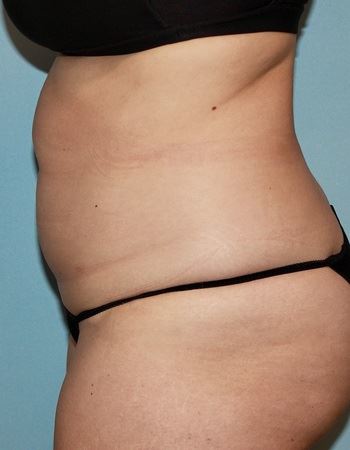Case 4 Abdomen: After