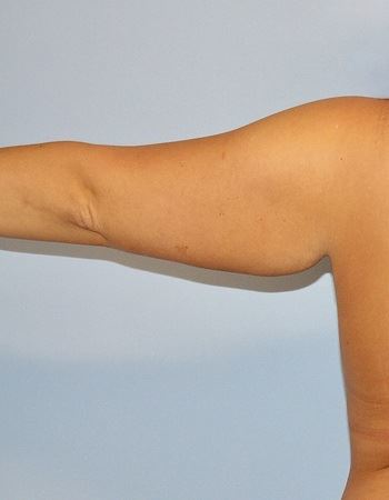 Case 5 Arm: Before