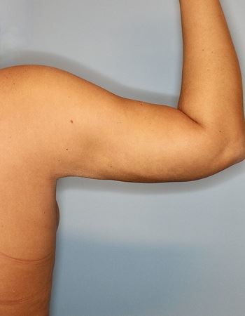 Case 5 Arm: After