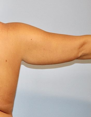 Case 5 Arm: Before