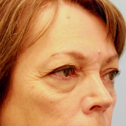 Blepharoplasty Before