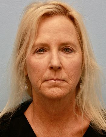 Case 1: Before Photo