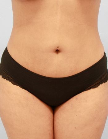 Case 1 Abdomen: After Photo