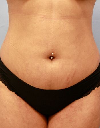 Case 1 Abdomen: Before Photo