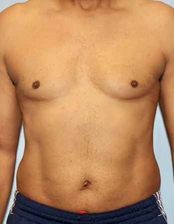 Case 1 Abdomen: After Photo