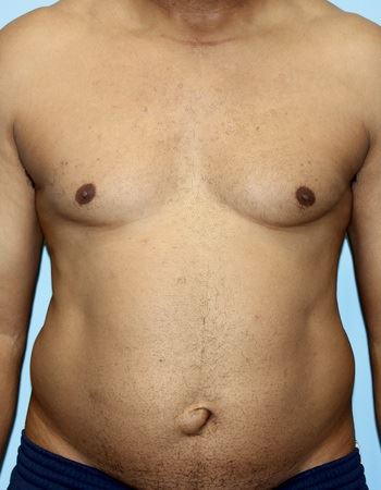 Case 1 Abdomen: Before Photo