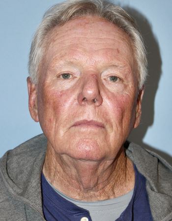 Case 1: Before Photo